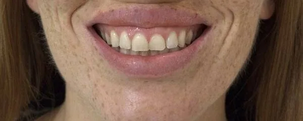 Gummy Smile prima
