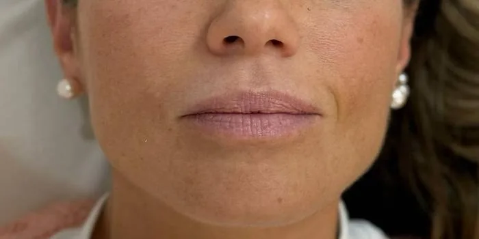 Filler labbra prima
